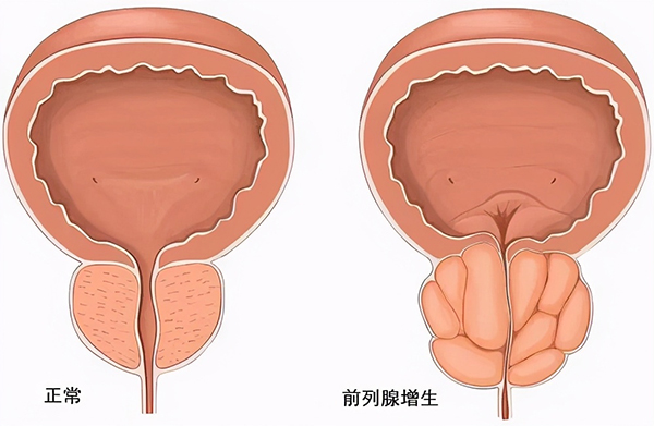 前列腺增生