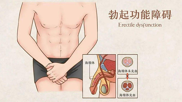 男性勃起功能障碍