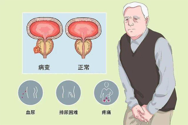 前列腺疾病如何预防？