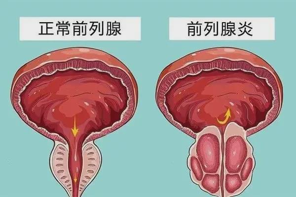 前列腺炎与肾虚