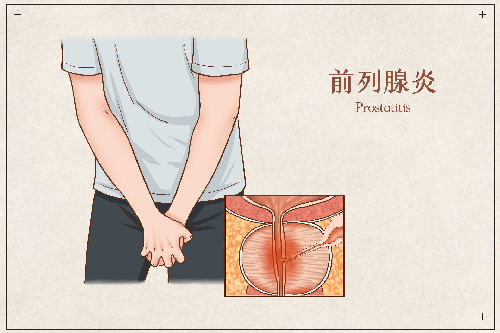 摄图网_401802458_前列腺炎医疗插画（企业商用）.jpg
