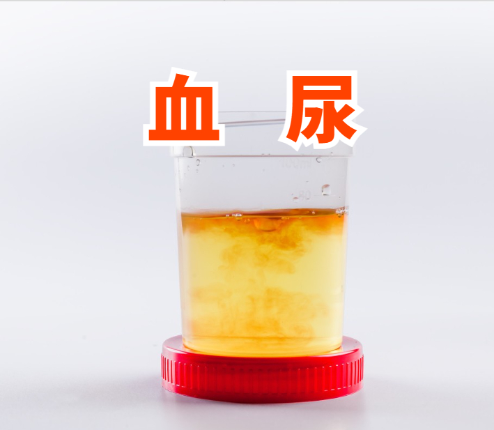 尿血需分型而治