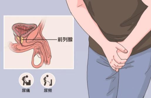 慢性前列腺炎有哪些症状？