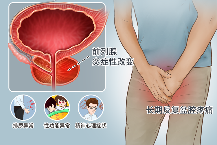 中医治疗前列腺炎