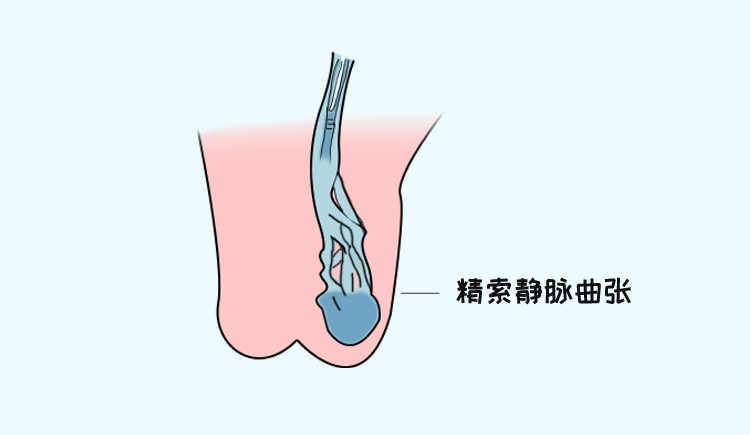 男性不育与精索静脉曲张有关？